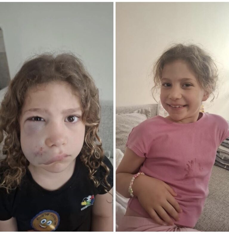 רוני בת 8 מגבעתיים נפצעה מקורקינט זרוק באמצע המדרכה ברחוב ההסתדרות בדרך הביתה מבית הספר